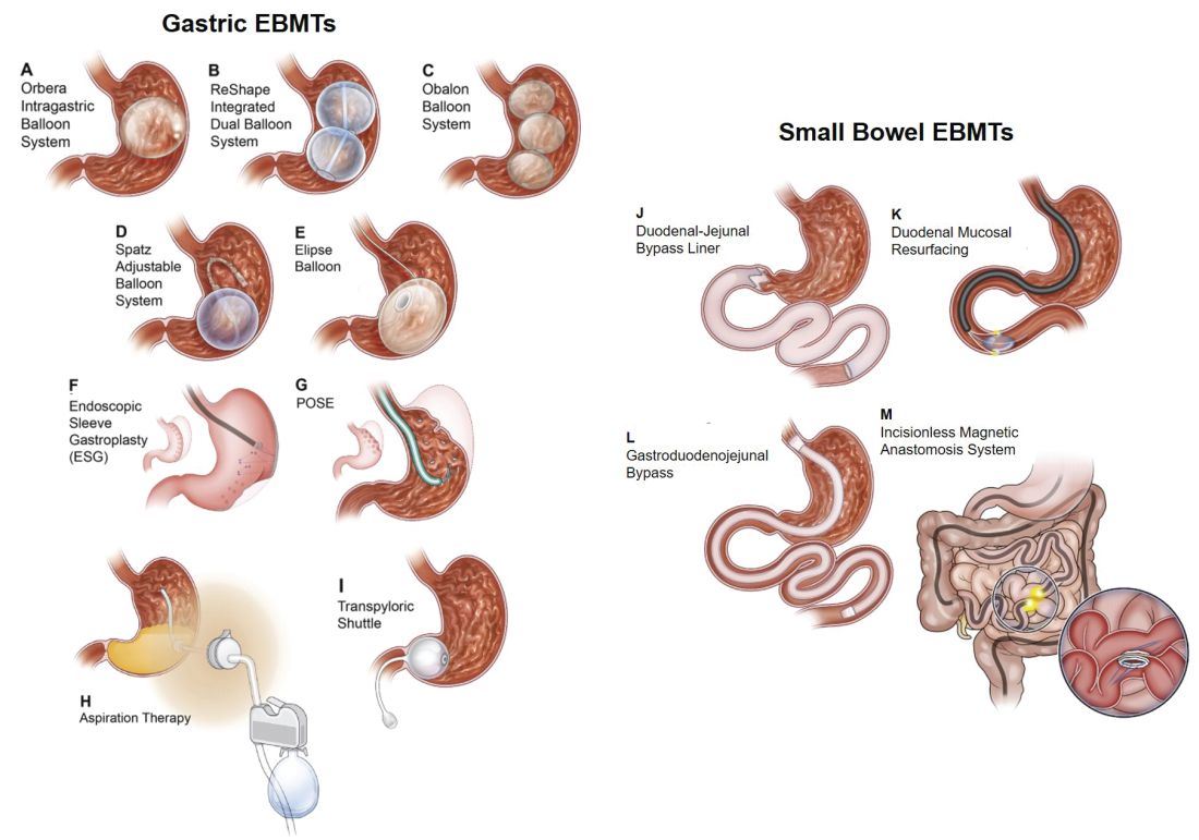 Endoscopic Management Of Obesity Gi And Hepatology News